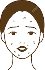ニキビ